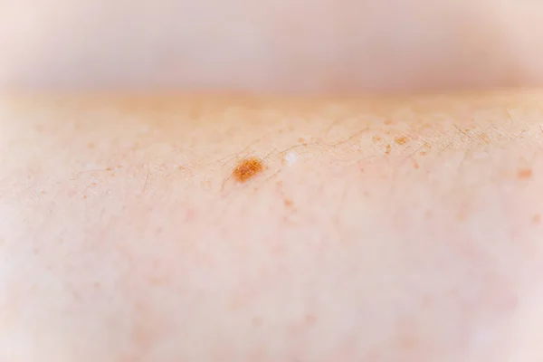 A birthmark or a mole on a woman skin — Stock Photo, Image