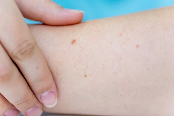 a birthmark or a mole on a woman skin