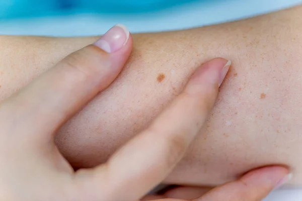 Una marca de nacimiento o un lunar en la piel de una mujer — Foto de Stock