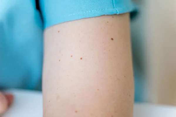 A birthmark or a mole on a woman skin — Stock Photo, Image