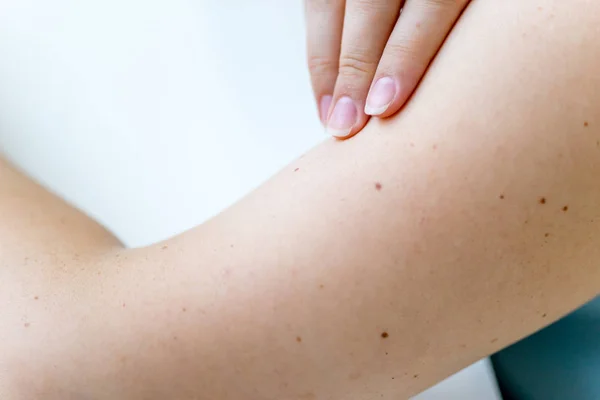 Uma marca de nascença ou uma toupeira na pele de uma mulher — Fotografia de Stock