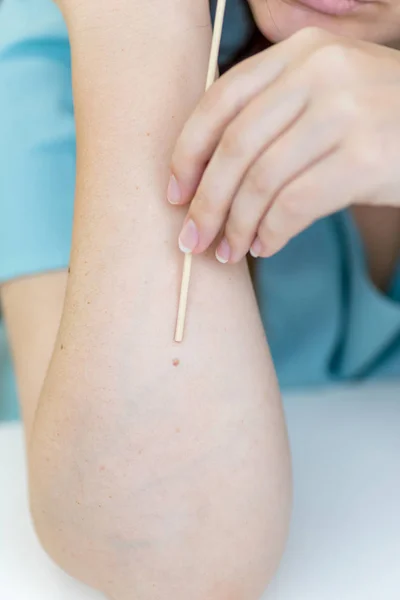 Una marca de nacimiento o un lunar en la piel de una mujer — Foto de Stock