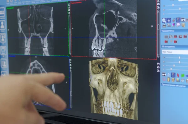 The doctor examines a X-ray examination of the maxillofacial region of the head on a computer monitor. — Stock Photo, Image