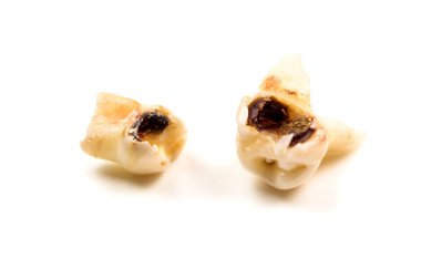 süt dişleri ile beyaz arka plan üzerinde büyük çürük molar