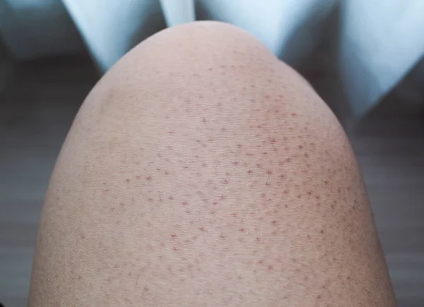 Probleme Der Körperhaut Große Poren Und Dunkle Farben Den Beinen — Stockfoto