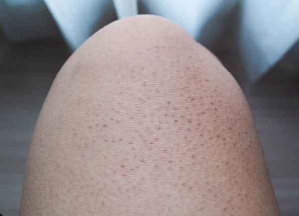 Problèmes Peau Corporelle Gros Pores Couleurs Foncées Sur Les Jambes — Photo