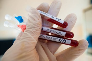 Corona virüsünü analiz etmek ve aşı üretmek için bir şişede kan örneği. Corona virüsü salgını