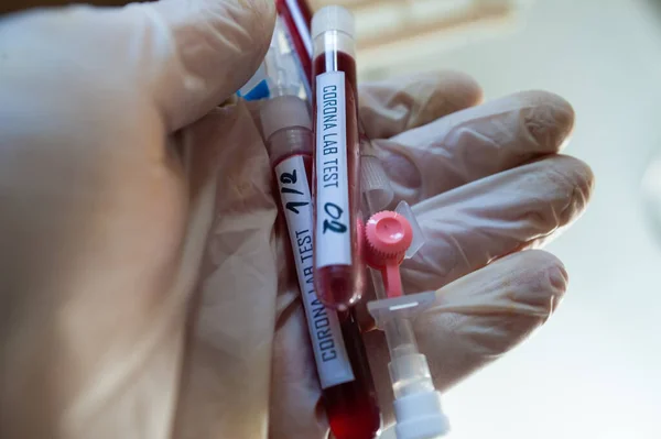 Krev Vzorek Baňce Pro Analýzu Viru Korony Výrobu Vakcíny Ohnisko — Stock fotografie