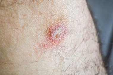 diz üzerinde yara yakın