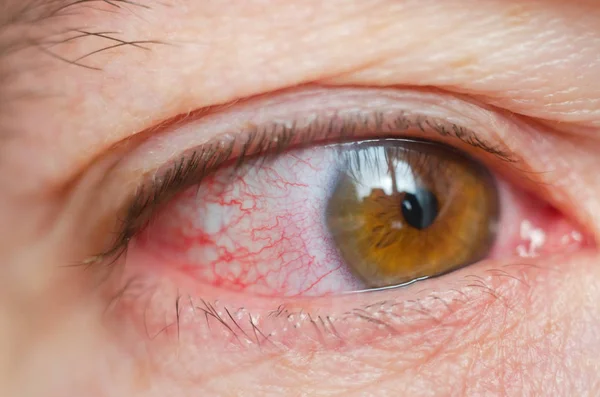 Closeup Irritado Infectado Olhos Vermelhos Sangue Conjuntivite — Fotografia de Stock
