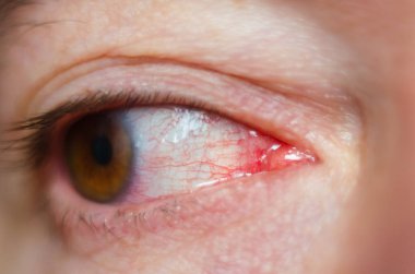 Virüslü kırmızı kan çanağı gözleri, konjonktivit closeup tahriş.