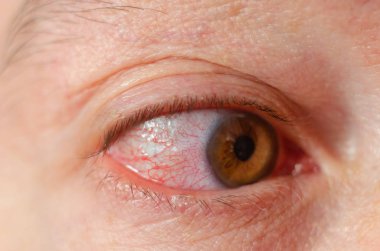 Virüslü kırmızı kan çanağı gözleri, konjonktivit closeup tahriş.