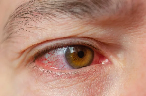 Closeup Geïrriteerd Geïnfecteerde Rode Bloeddoorlopen Ogen Conjunctivitis — Stockfoto