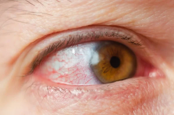 Closeup Irritado Infectado Olhos Vermelhos Sangue Conjuntivite — Fotografia de Stock
