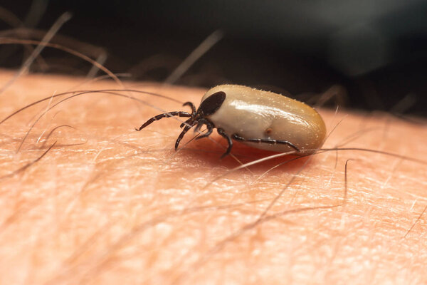 A tick drunk on blood crawls on human skin.