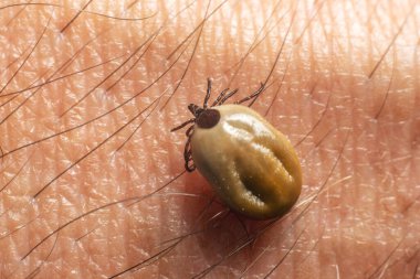 A tick drunk on blood crawls on human skin. clipart