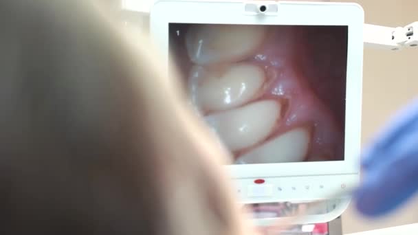 Intraoral camera monitor mouth inside view — Stock Video