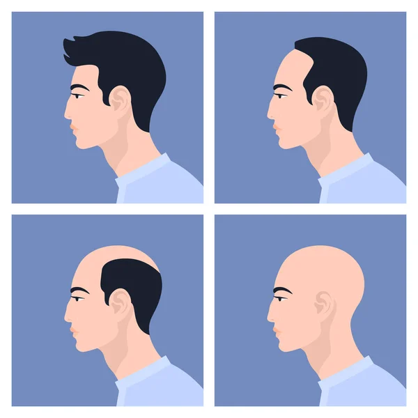 Stadier Manligt Håravfall Håravfall Alopeci Asiatiska Män Flat Vektorillustration — Stock vektor