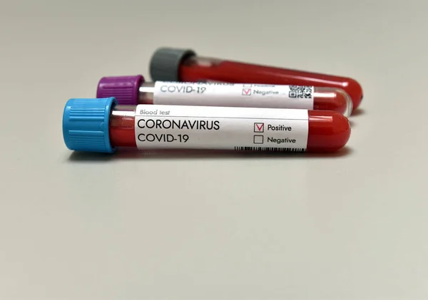 Coronavirus Covid 19 infected positive result blood test sample in research tube in laboratory where vaccine research is tested on Covid-19. Close-up