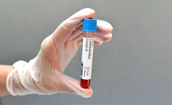 Koronavirüslü test tüpü kan testi pozitif sonuç verdi. Yakın plan..