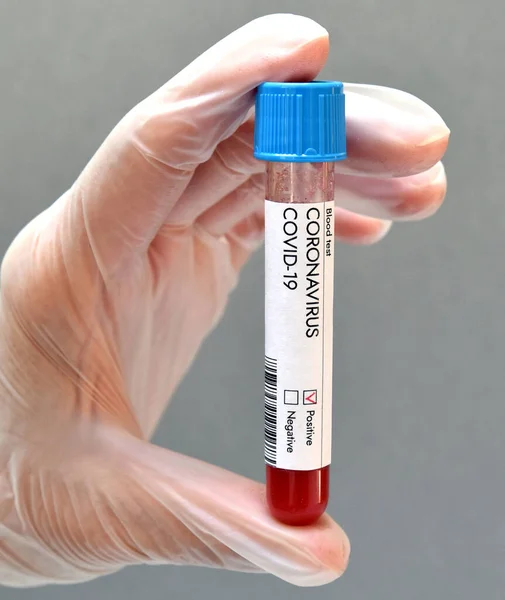 Coronavirus pozitif test sonucu kan örneği. Yakın plan.