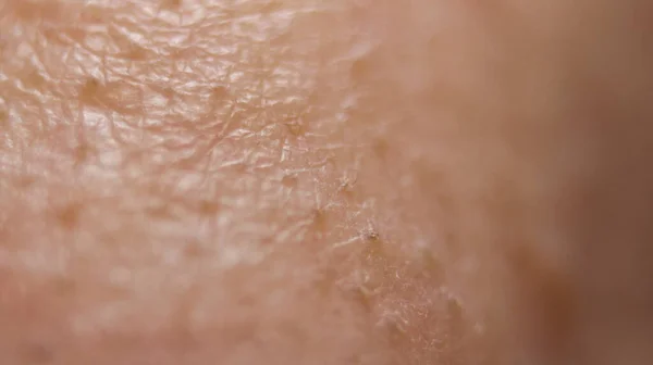 Macro Skin Detail Black Heads — Stock Photo, Image