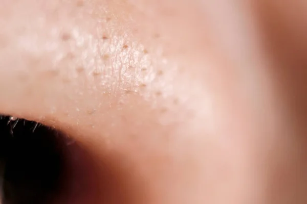 Macro Skin Detail Black Heads — Stock Photo, Image