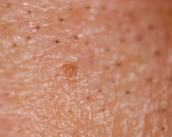 Macro Skin Detail Black Heads — Stock Photo, Image