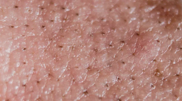 Macro Skin Detail Black Heads — Stock Photo, Image