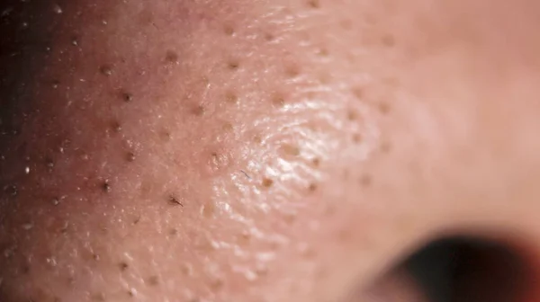 Macro Skin Detail Black Heads — Stock Photo, Image