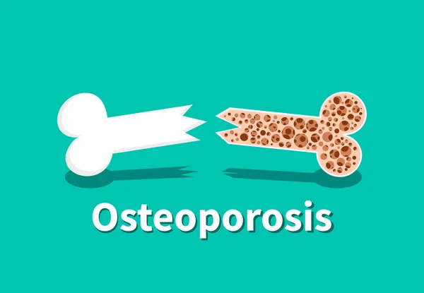 Osteoporosis, estructura ósea en el diseño de arte vectorial — Vector de stock