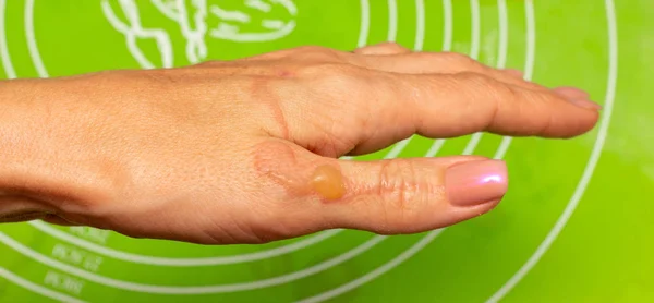 Ustioni Vesciche Olio Bollente Sulla Mano Della Donna Primo Piano — Foto Stock