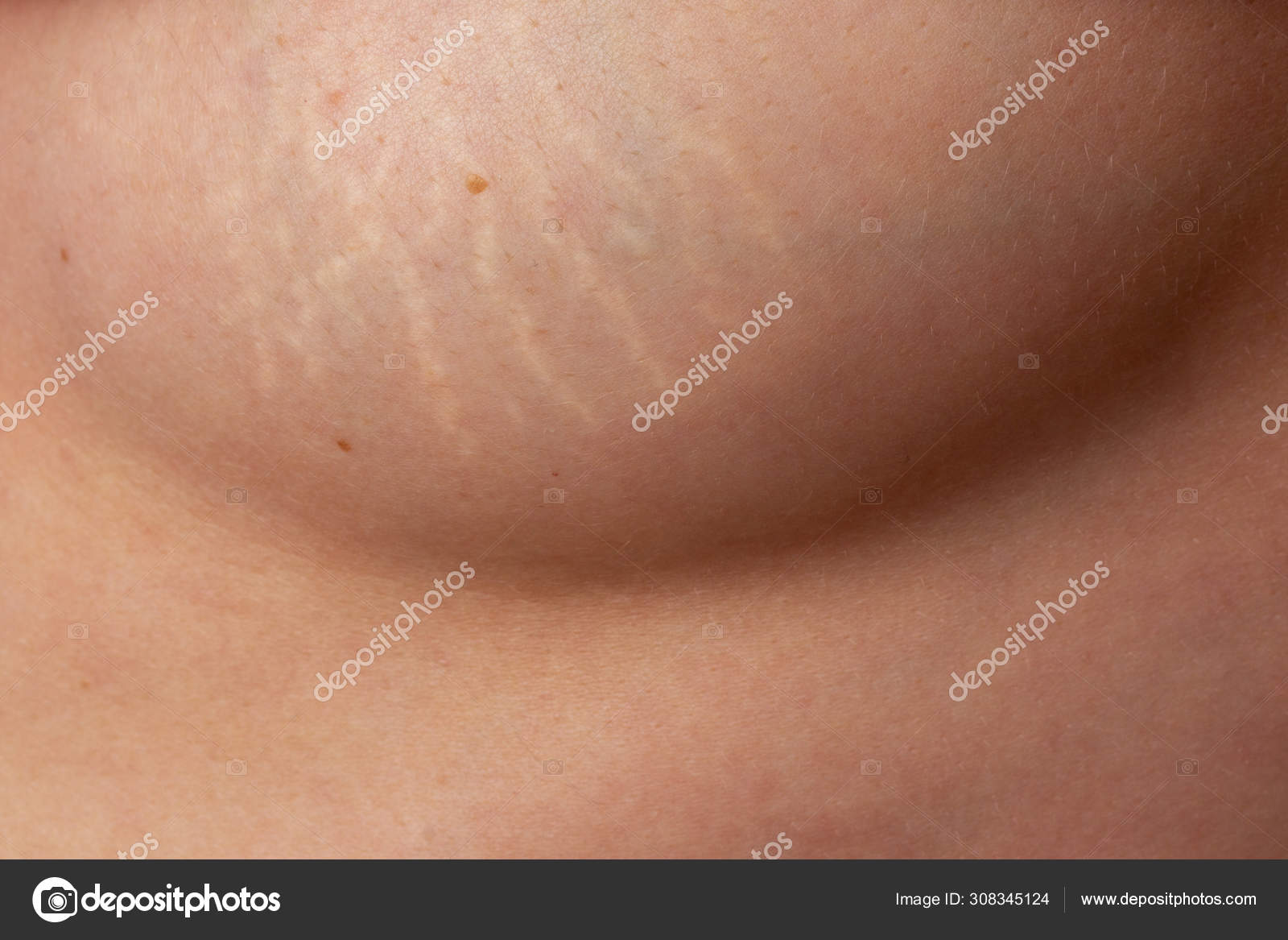 Stretch Marks On Boobs