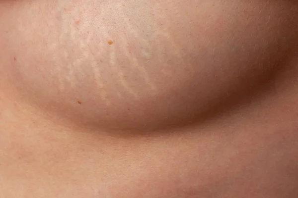 分娩后年轻妇女乳房上的拉伸痕迹 — 图库照片