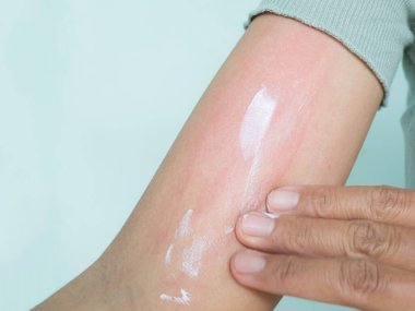 Elinizde Gıda, Hava Zehirlenmesi, Kozmetik, Sağlık, Vücut Bakımı Hastalığı Zambakları Havası, Hastalık İlacı Kremi, Kalamin Tedavisi, Enfeksiyon Hastalığı Tırmalama,.