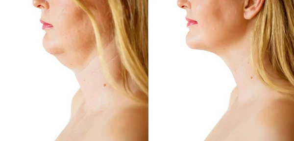 あごの脂肪の訂正のプロシージャの前後の女性 — ストック写真