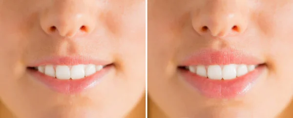 Woman Lips Filler Injections — Stock Photo, Image