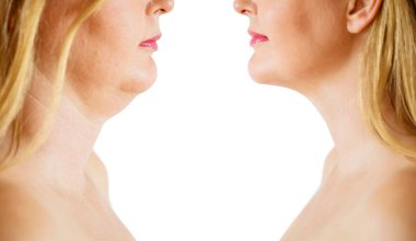 Double chin fat or dewlap correction, before and after clipart