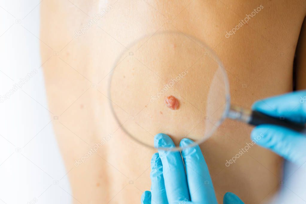 Dermatologist looking ar birthmark on patient's skin