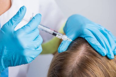 Doktor kozmetoloji uzmanı daha güçlü ve sağlıklı saçlar için kadının kafasına mezoterapi enjeksiyonları yapıyor.