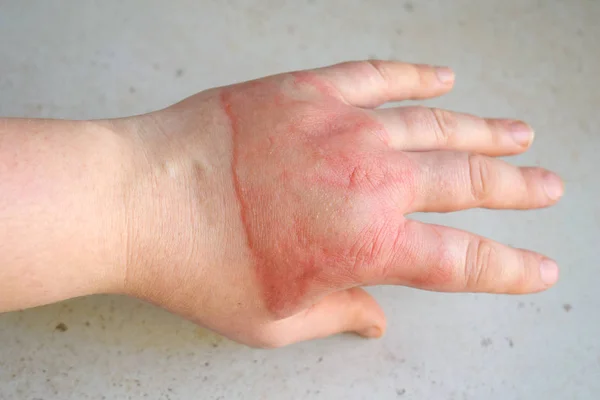 Horrible Quemaduras Segundo Grado Mano Femenina Sobre Fondo Blanco — Foto de Stock