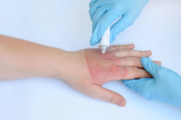 Mãos Médico Segurando Mão Feminina Com Queimaduras Segundo Grau Fundo — Fotografia de Stock