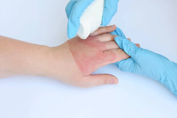 Mãos Médico Segurando Mão Feminina Com Queimaduras Segundo Grau Fundo — Fotografia de Stock