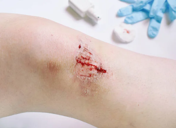 膝盖上血淋淋的伤口的特写 用防腐剂进行伤口处理 — 图库照片