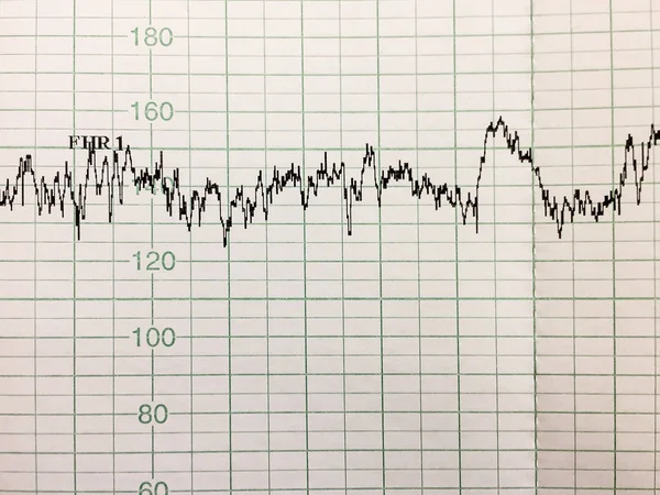 Impresión Del Informe Del Cardiograma Electrocardiografía Primer Plano —  Fotos de Stock