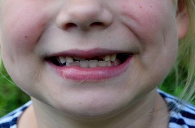 Yeni boşluğunu gösteren genç bir kız. Süt dişleri olmadan gülümseyen küçük kız, yakın plan.