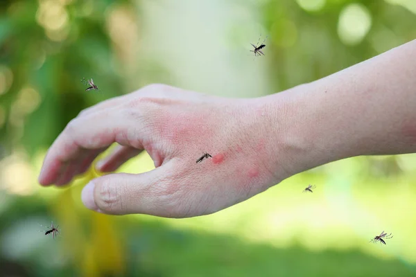 Укус Комарів Руці Дорослих Зробив Шкірний Висип Алергію Червону Пляму — стокове фото