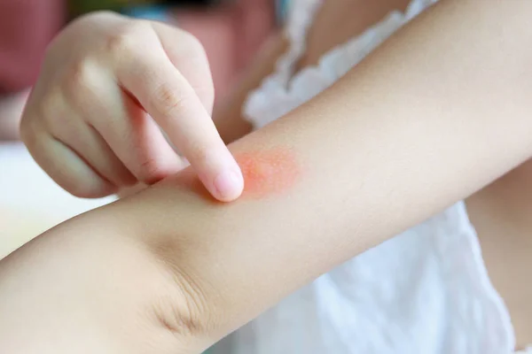 Kislánynak Bőrkiütése Van Allergiás Szúnyogcsípésre — Stock Fotó