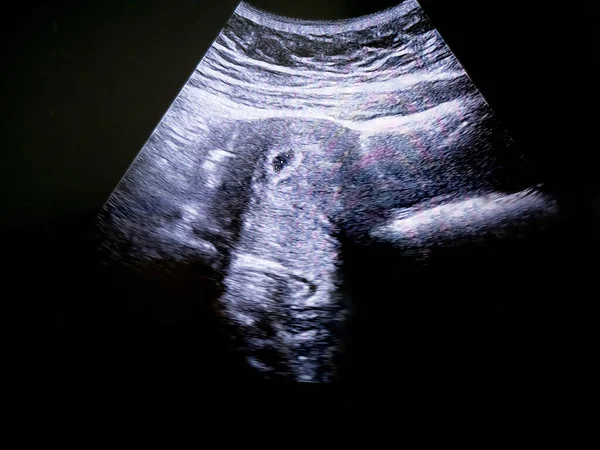 Ultra Som Embrião Semanas Mulher Grávida — Fotografia de Stock