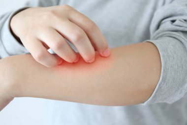 Genç Asyalı kadın kaşındırıyor ve kollarını kaşındırıyor kuru cilt egzama dermatiti yüzünden.